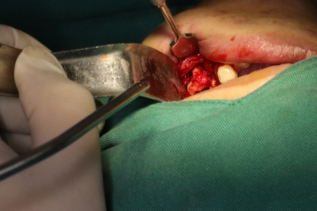 我的2021-下颌牙瘤摘除