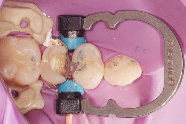 我的2022-右上后牙树脂充填一例