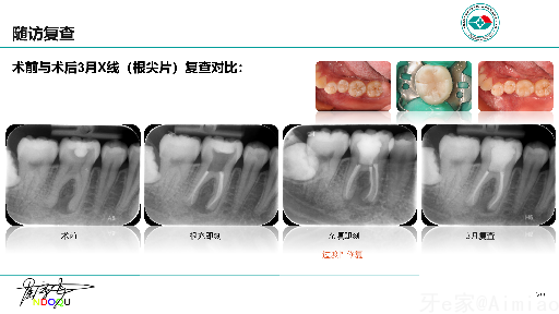 我的2022-右下后牙慢性根尖周炎诊疗一例