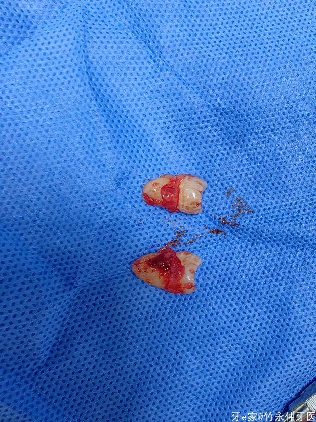 高位近中阻生的上颌智齿