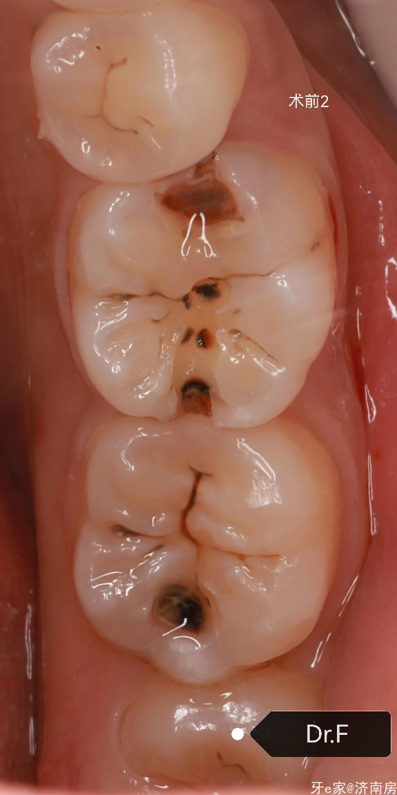 46.47美塑树脂修复