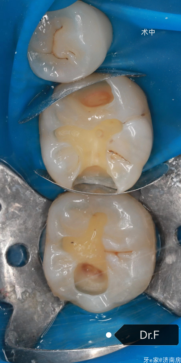 46.47美塑树脂修复